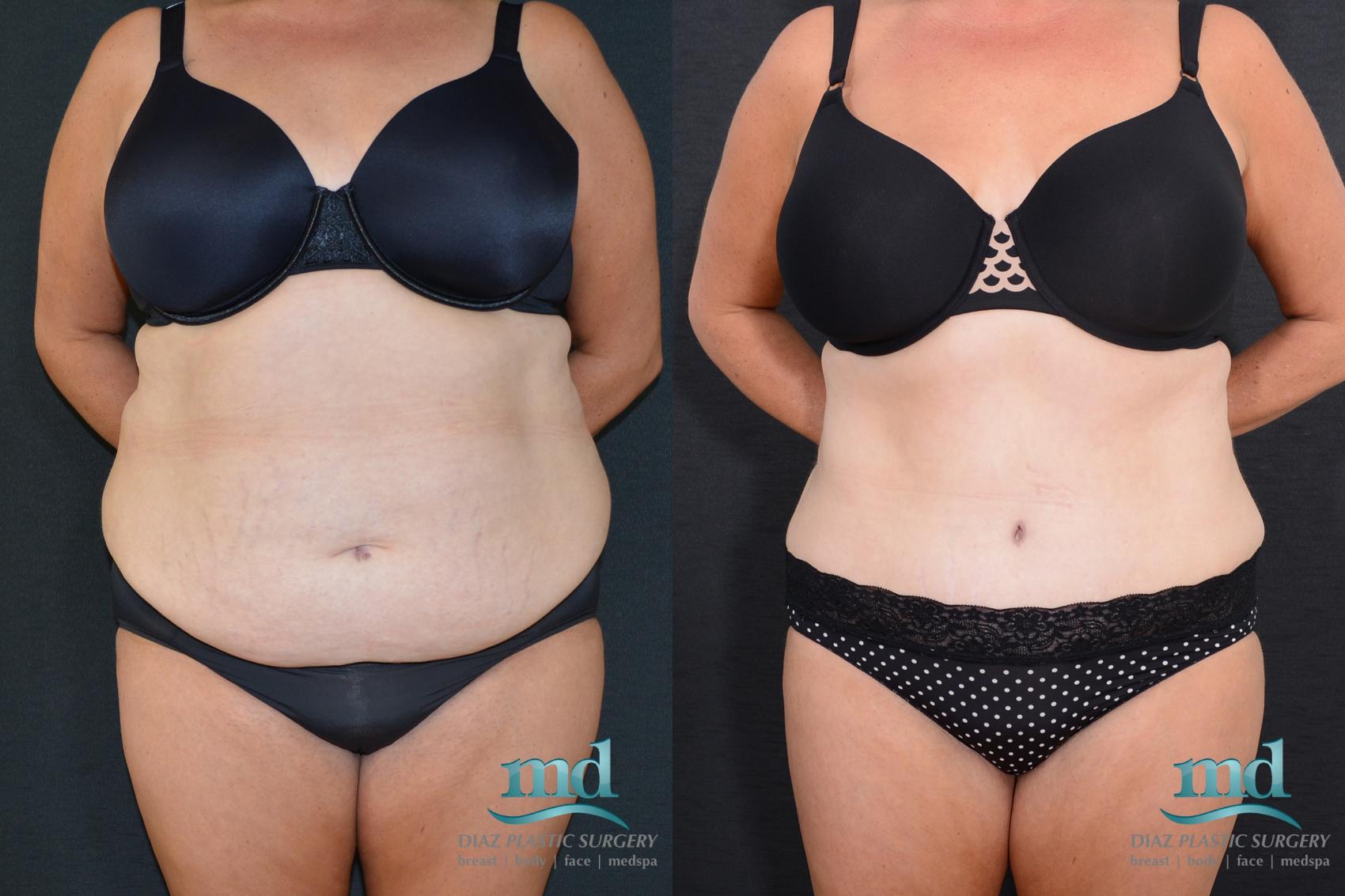Before & After Tummy Tuck Case 18 View #1 View in Melbourne, FL