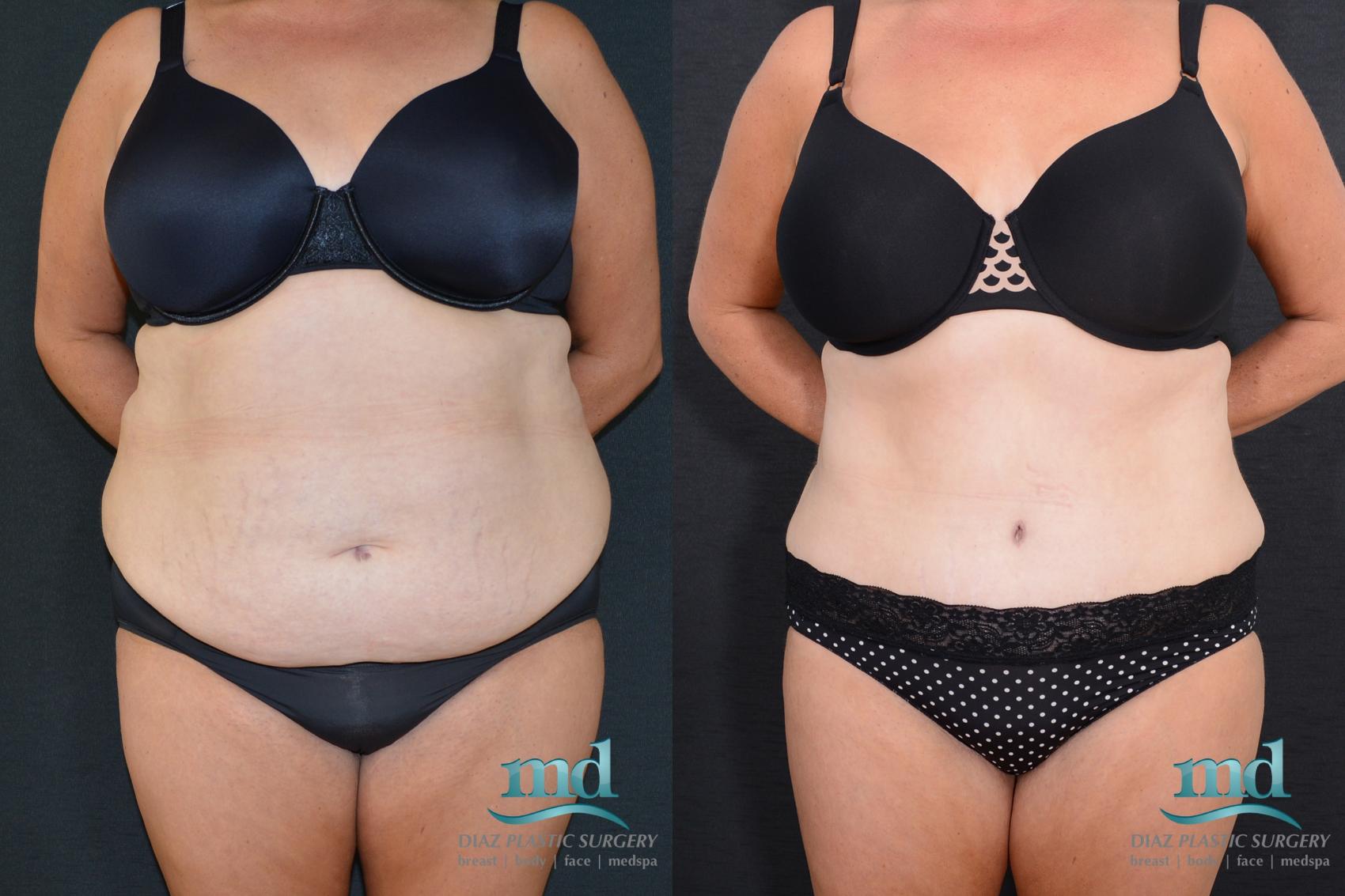 Tummy tuck cost in kenya Cosmetic Surgery Tips