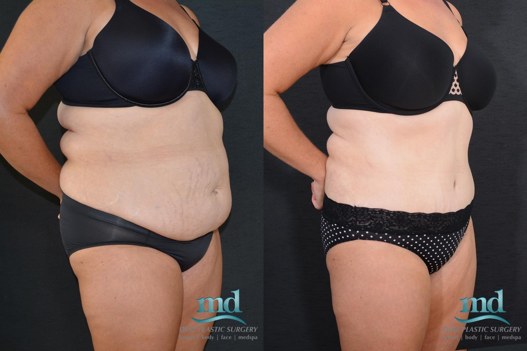 Before & After Tummy Tuck Case 18 View #2 View in Melbourne, FL