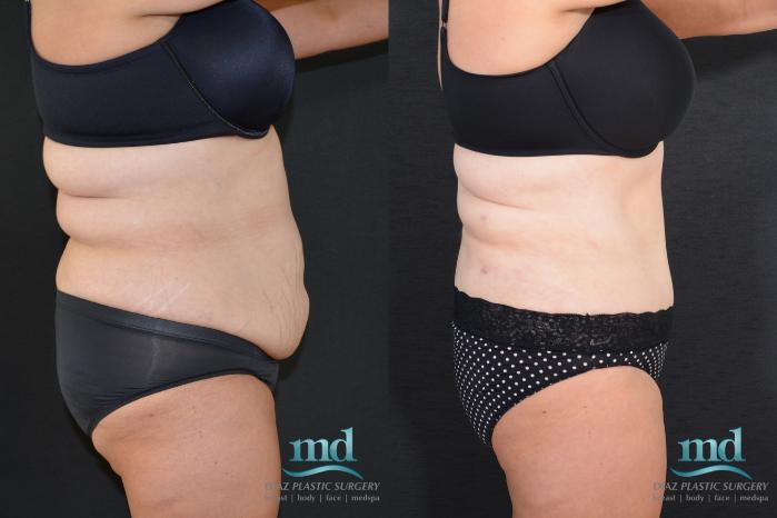Before & After Tummy Tuck Case 18 View #3 View in Melbourne, FL