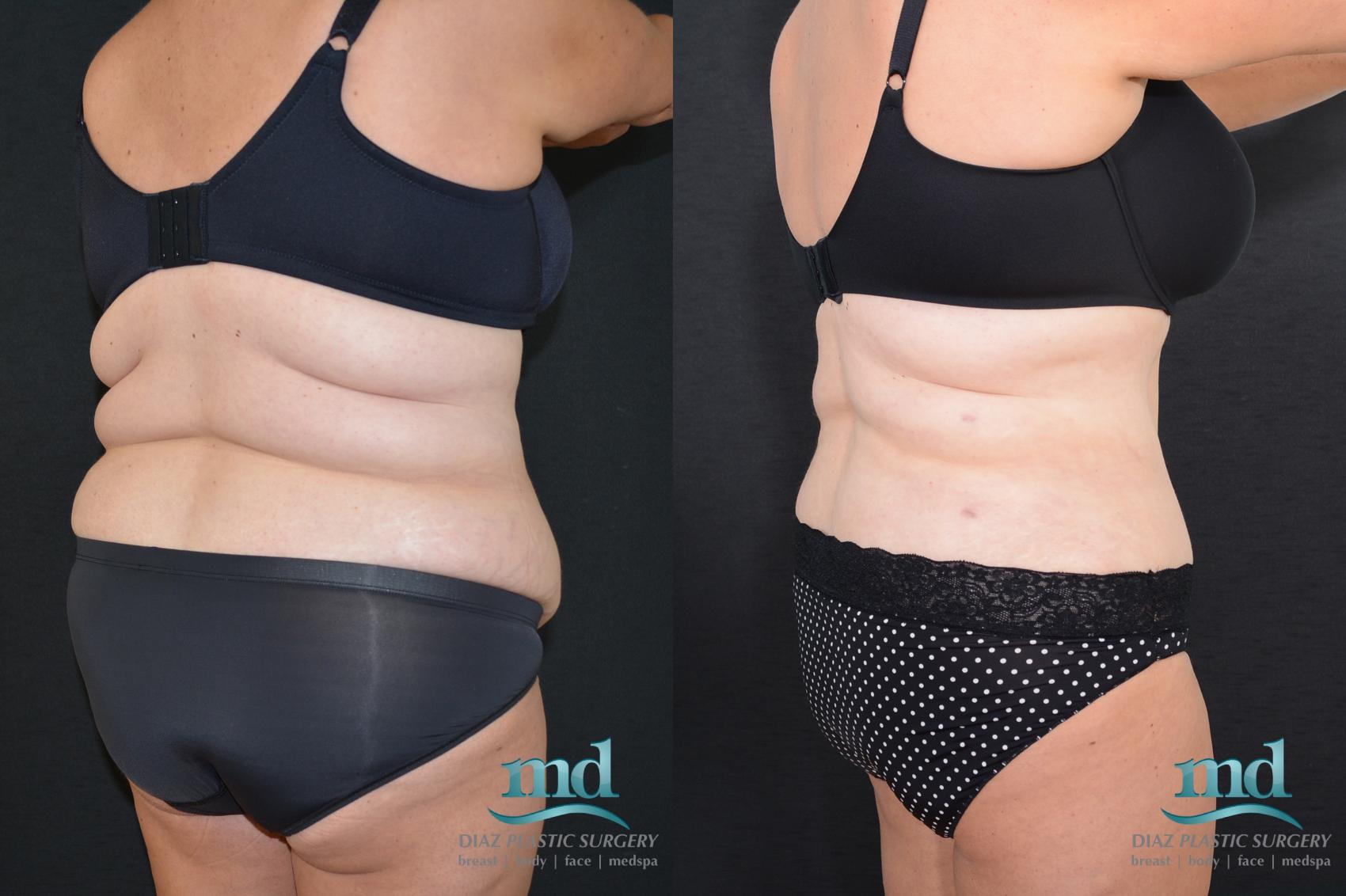Before & After Tummy Tuck Case 18 View #4 View in Melbourne, FL