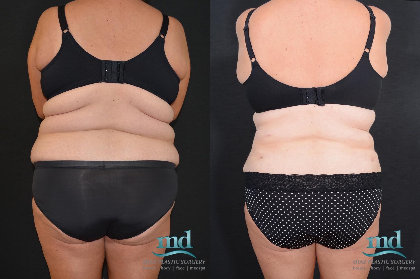 Before & After Tummy Tuck Case 18 View #5 View in Melbourne, FL