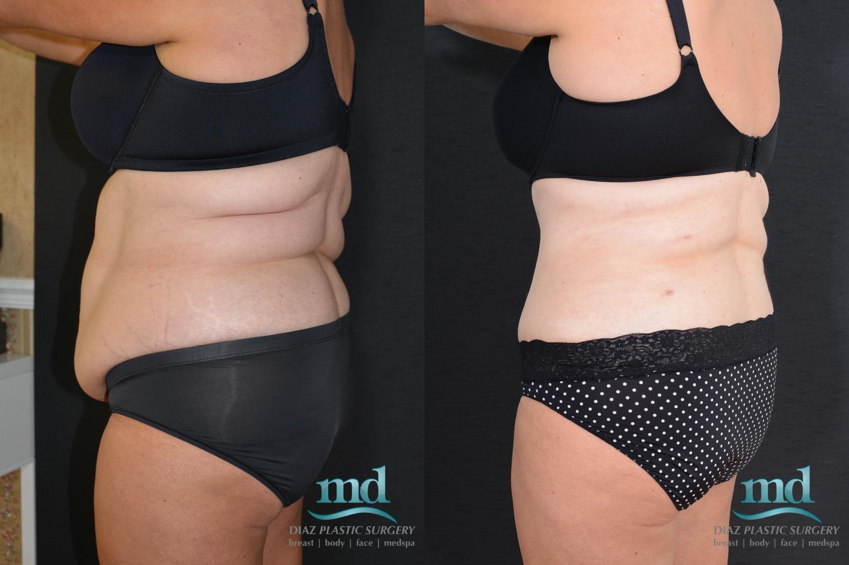 Before & After Tummy Tuck Case 18 View #6 View in Melbourne, FL