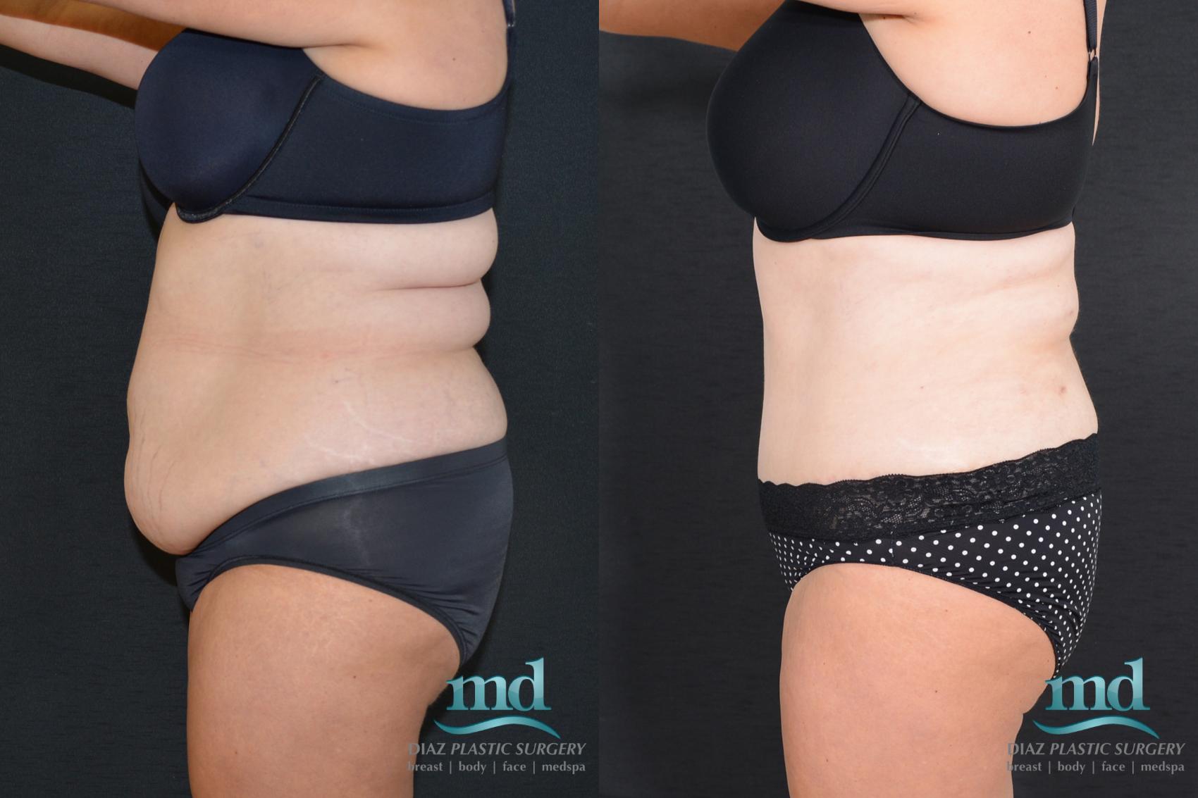 Before & After Tummy Tuck Case 18 View #7 View in Melbourne, FL