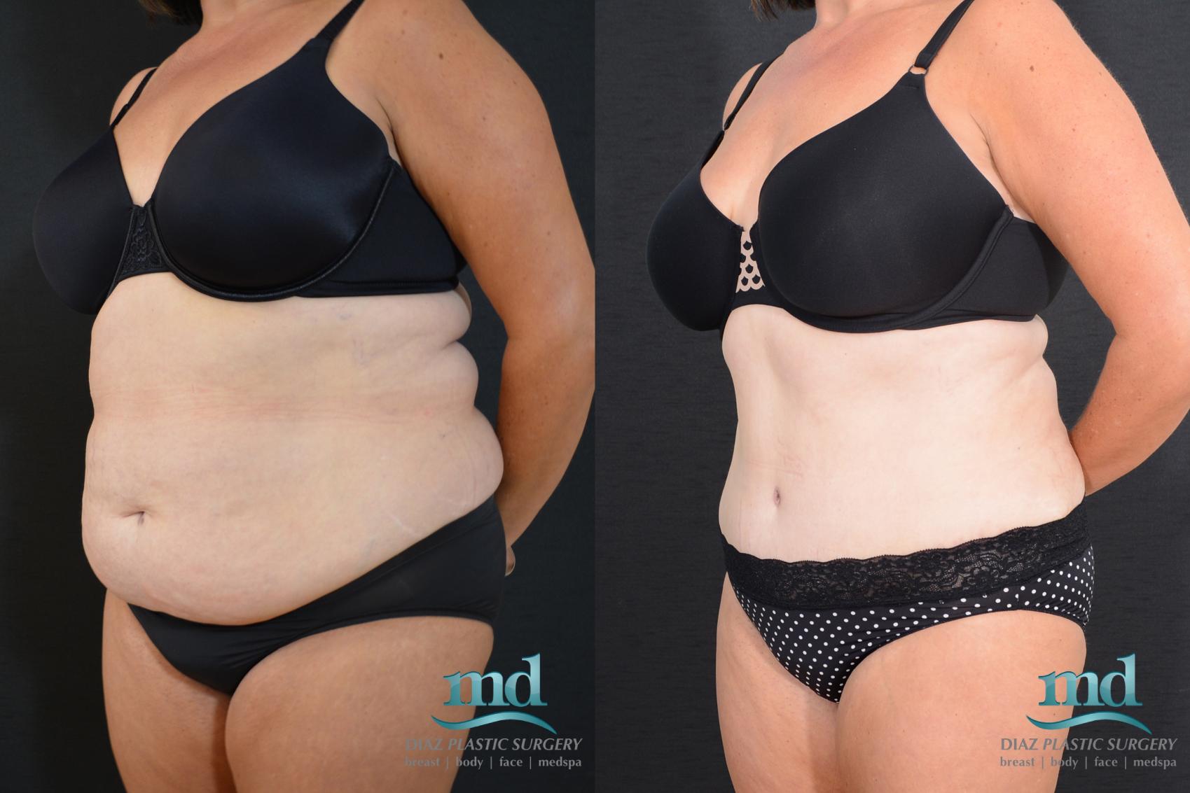 Before & After Tummy Tuck Case 18 View #8 View in Melbourne, FL