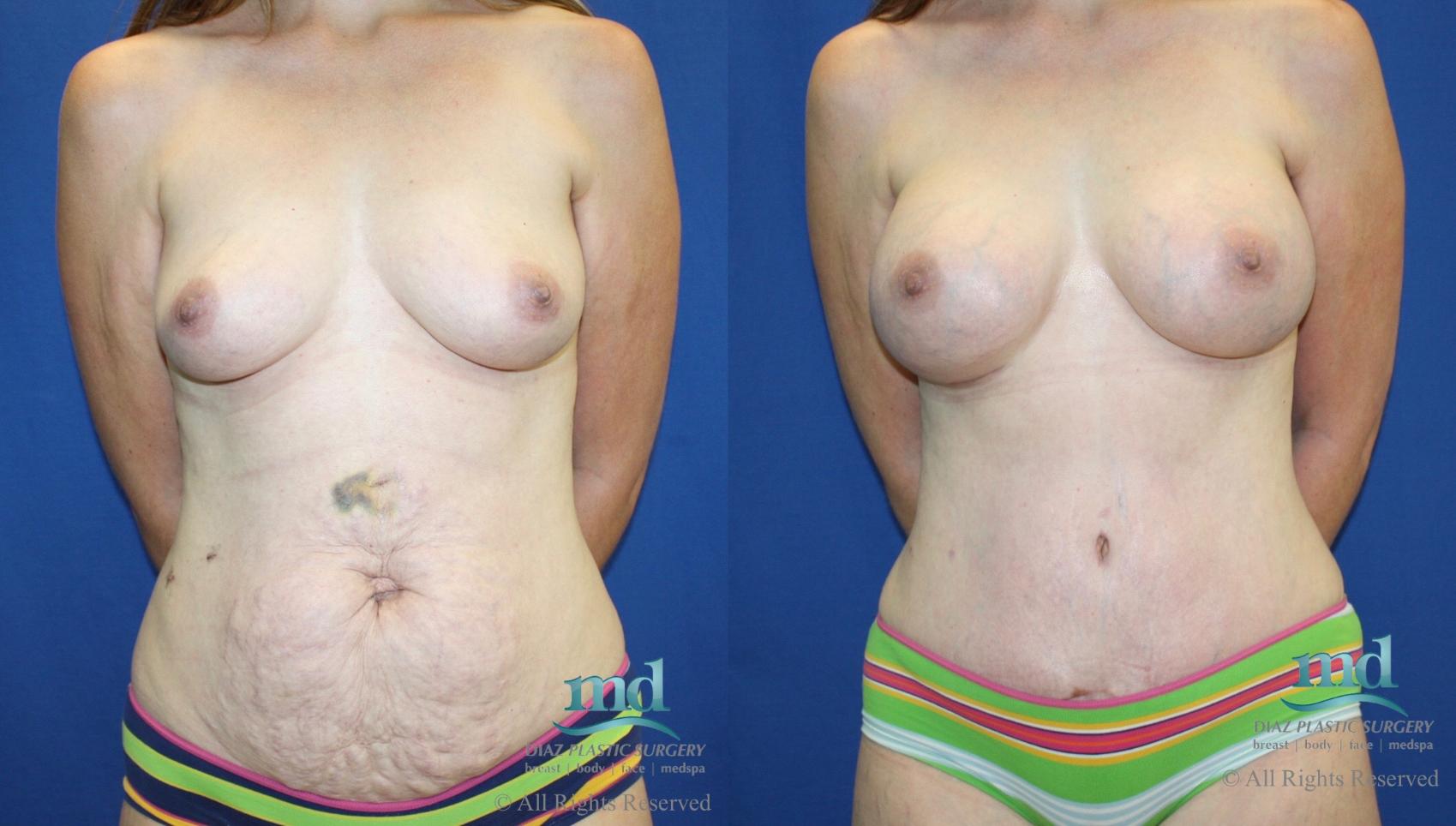 Before & After Tummy Tuck Case 26 View #1 View in Melbourne, Viera, Brevard County, FL