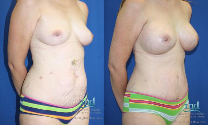 Before & After Tummy Tuck Case 26 View #2 View in Melbourne, FL