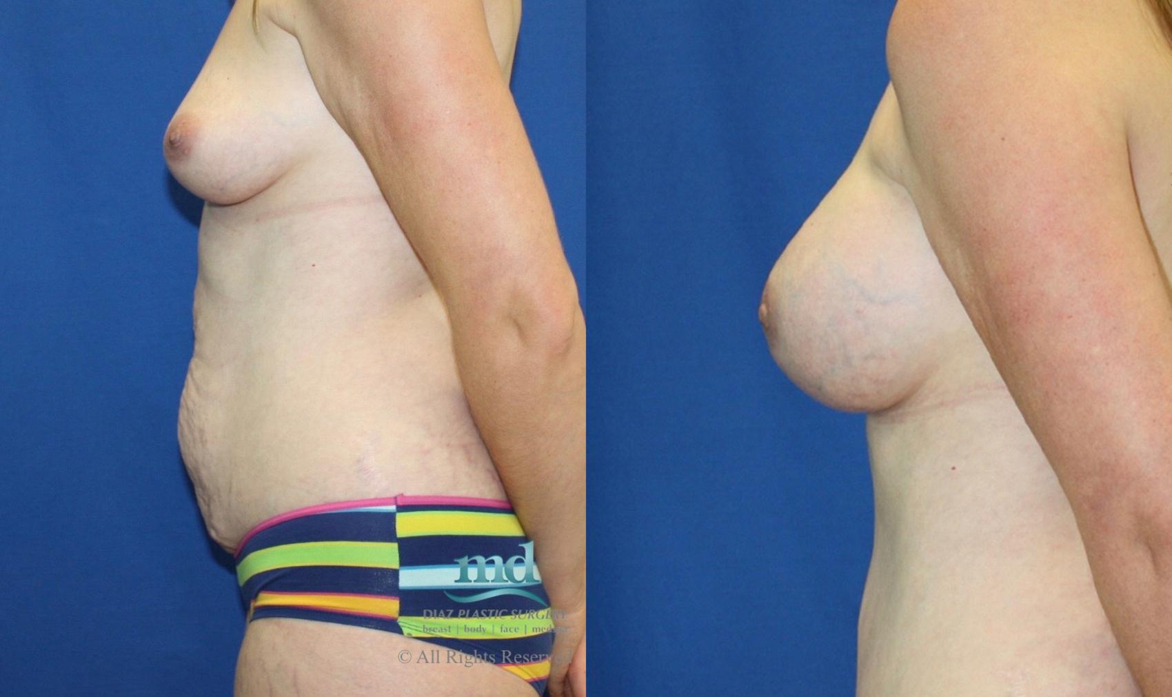 Before & After Tummy Tuck Case 26 View #3 View in Melbourne, FL