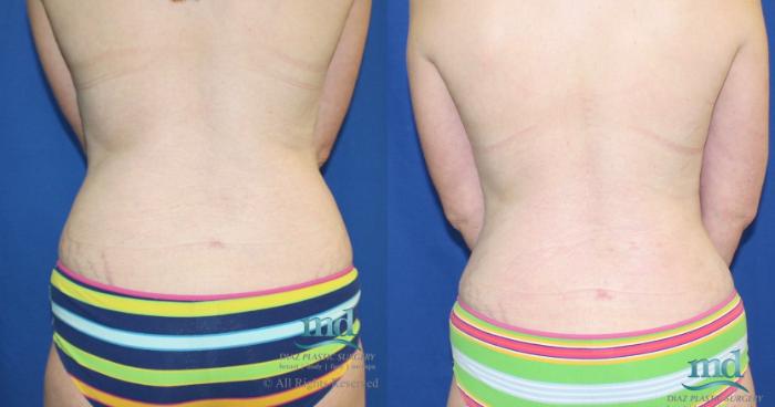 Before & After Tummy Tuck Case 26 View #4 View in Melbourne, FL