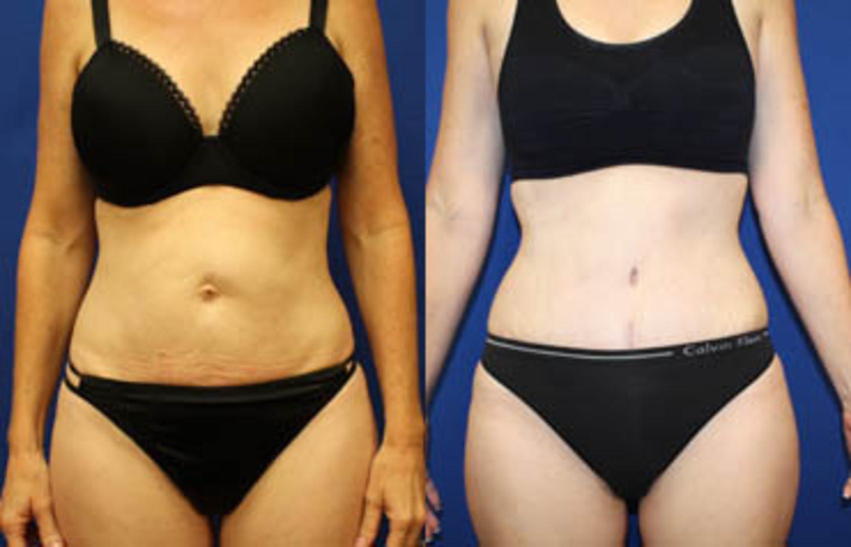 Before & After Tummy Tuck Case 27 View #1 View in Melbourne, FL
