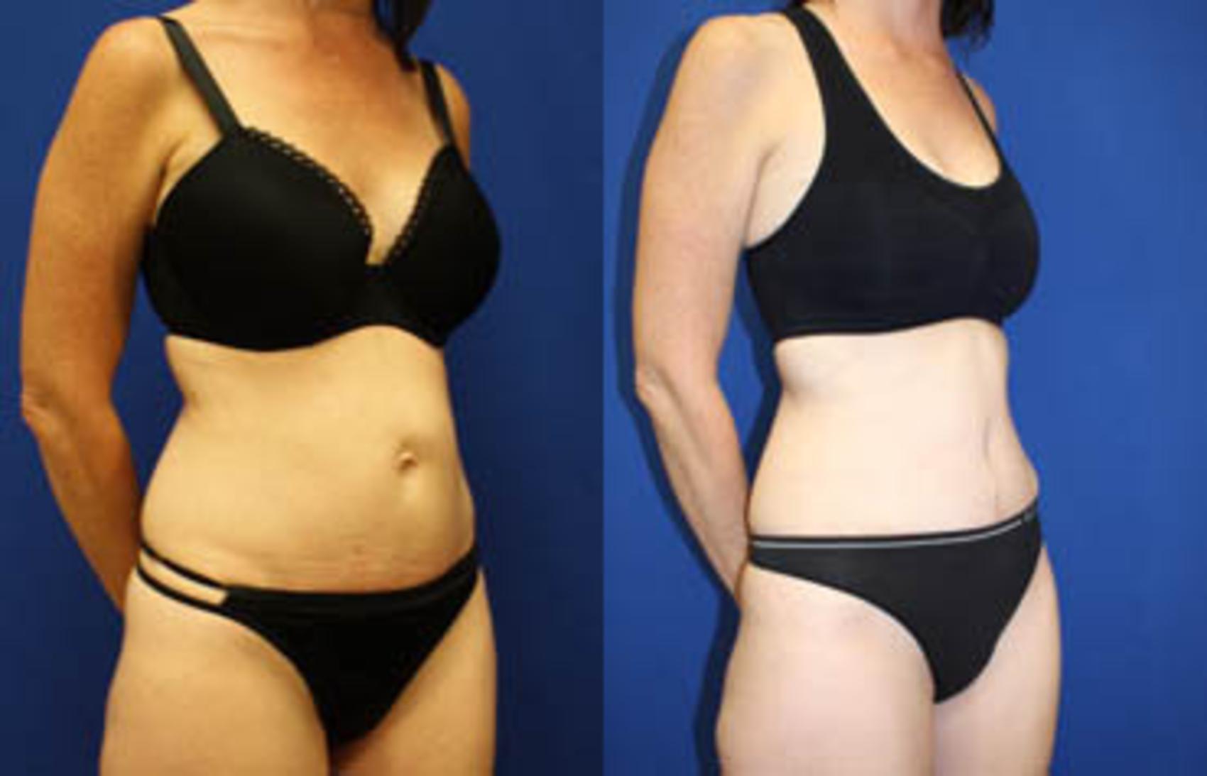 Before & After Tummy Tuck Case 27 View #3 View in Melbourne, FL