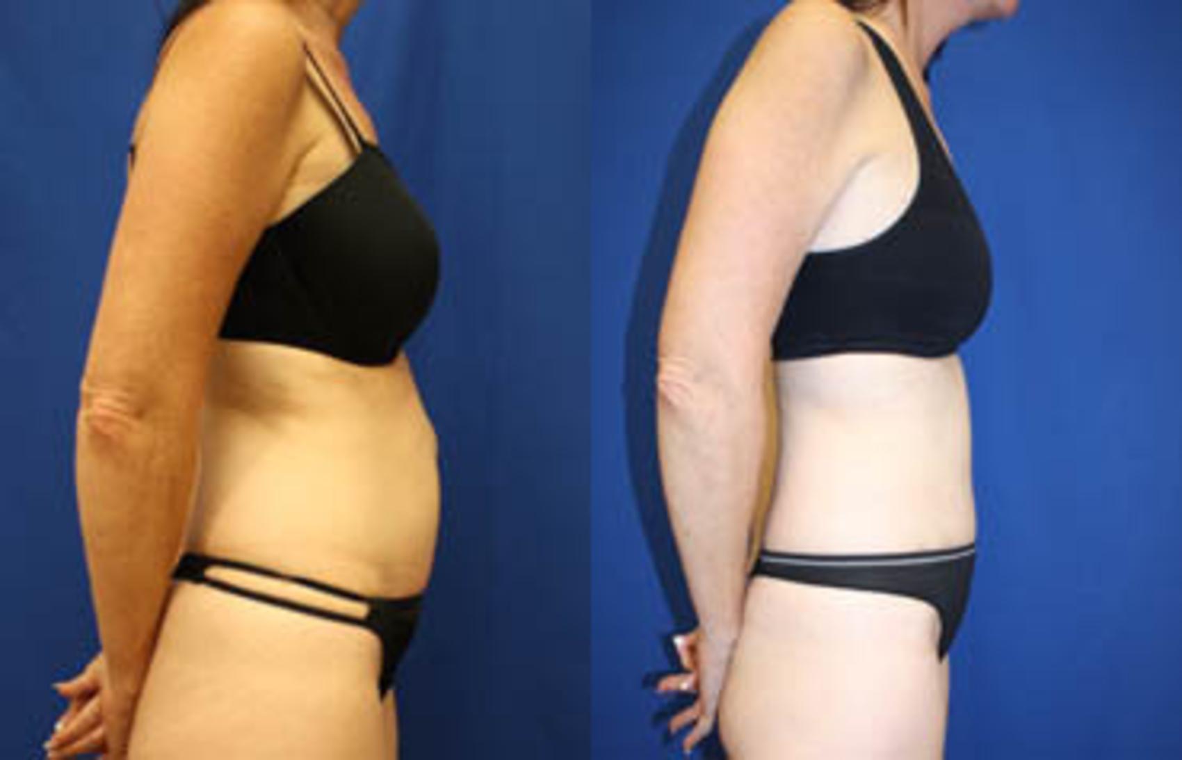 Before & After Tummy Tuck Case 27 View #4 View in Melbourne, FL