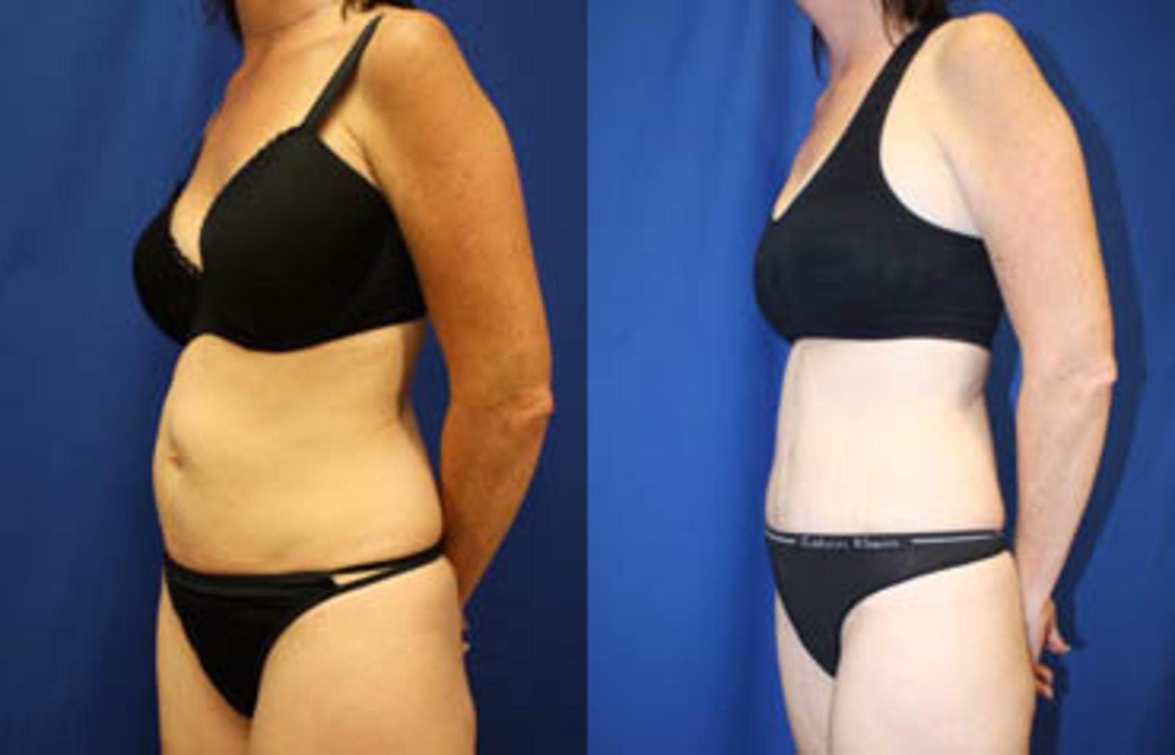 Before & After Tummy Tuck Case 27 View #5 View in Melbourne, FL