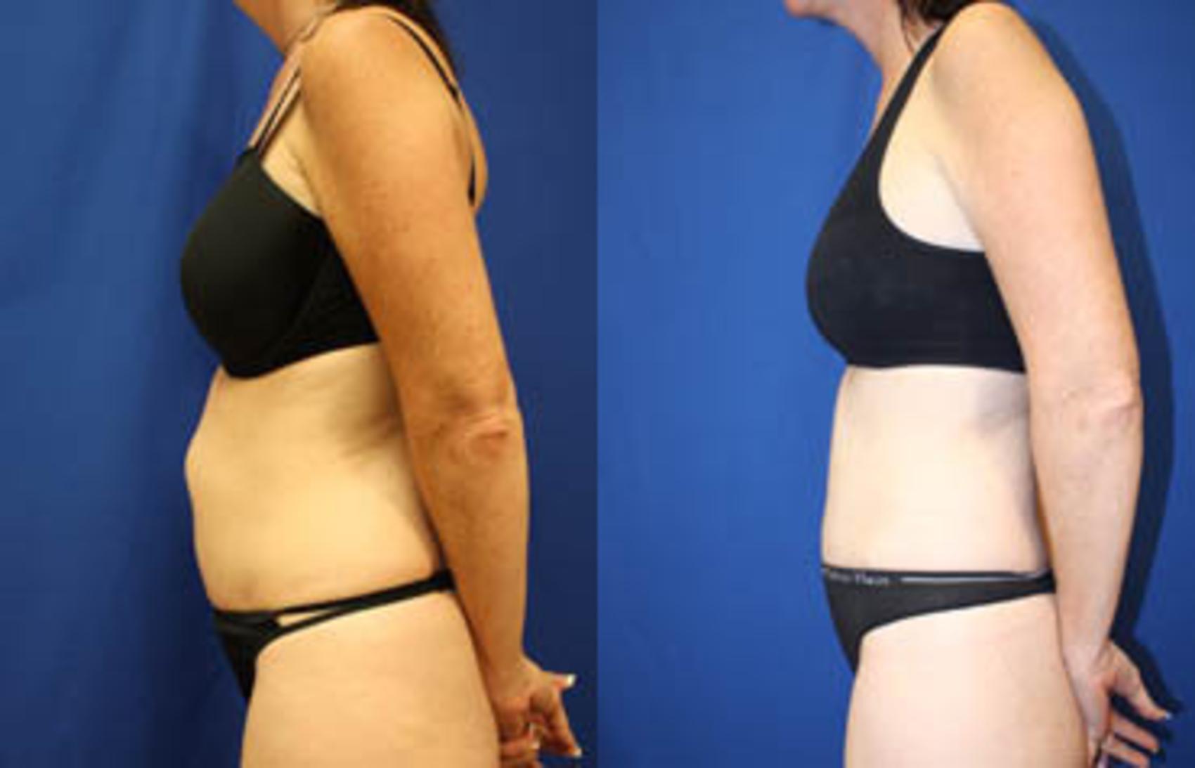 Before & After Tummy Tuck Case 27 View #6 View in Melbourne, FL