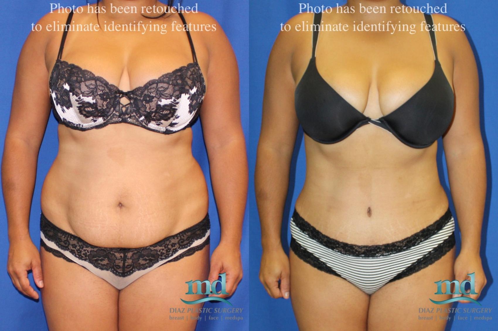 Before & After Tummy Tuck Case 39 View #1 View in Melbourne, FL