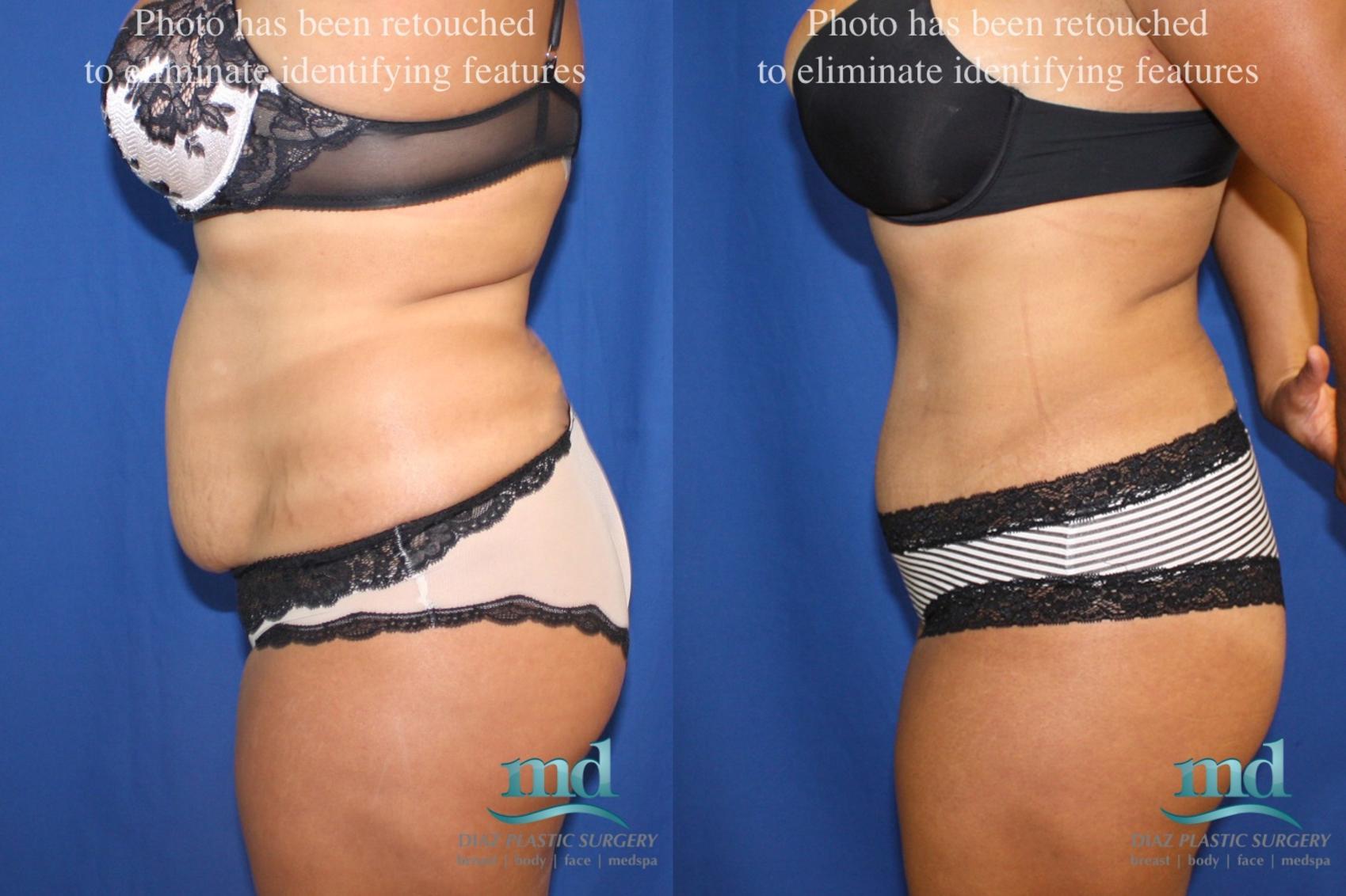 Before & After Tummy Tuck Case 39 View #3 View in Melbourne, FL