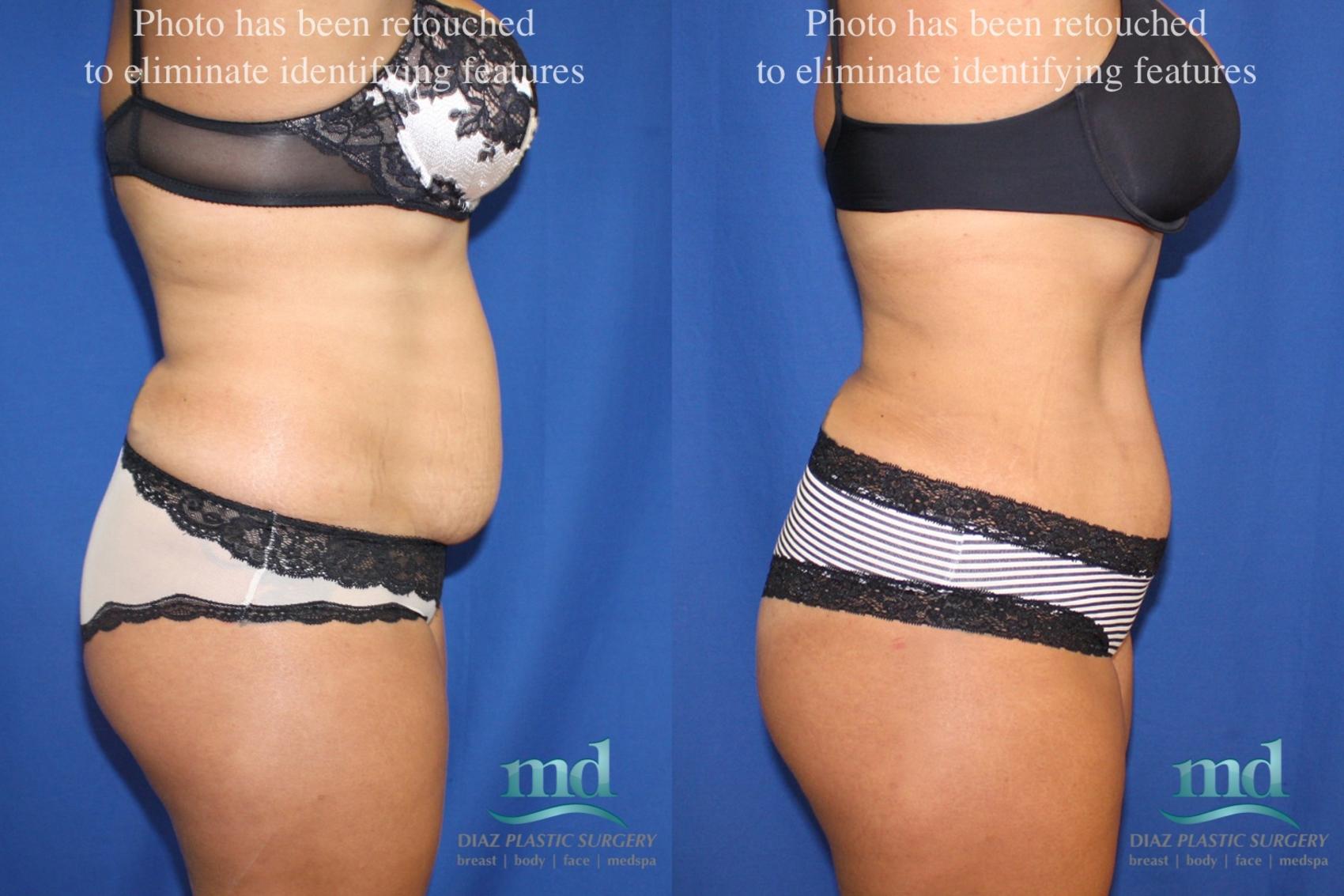 Before & After Tummy Tuck Case 39 View #7 View in Melbourne, FL