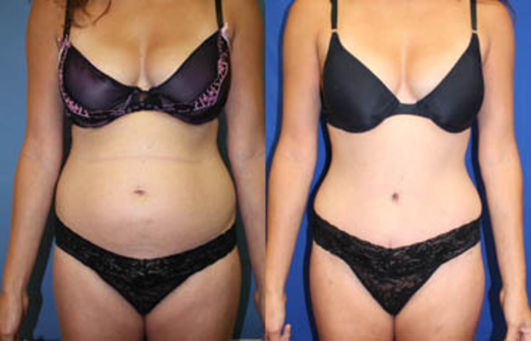 Before & After Tummy Tuck Case 7 View #1 View in Melbourne, FL