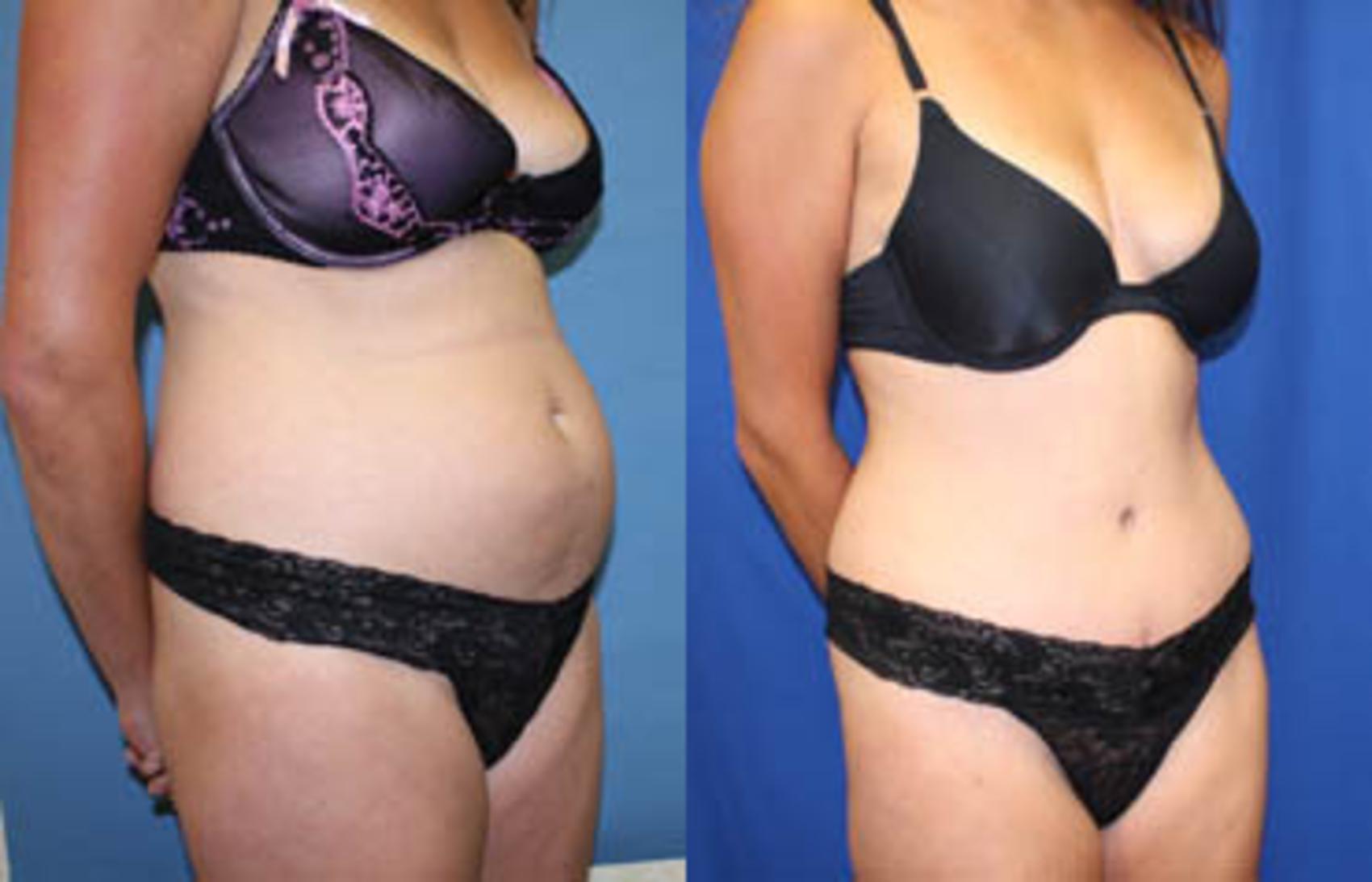 Before & After Tummy Tuck Case 7 View #2 View in Melbourne, FL