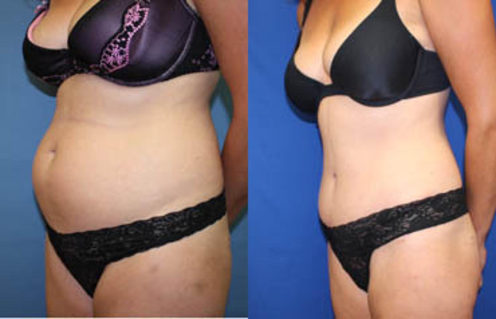Before & After Tummy Tuck Case 7 View #3 View in Melbourne, FL
