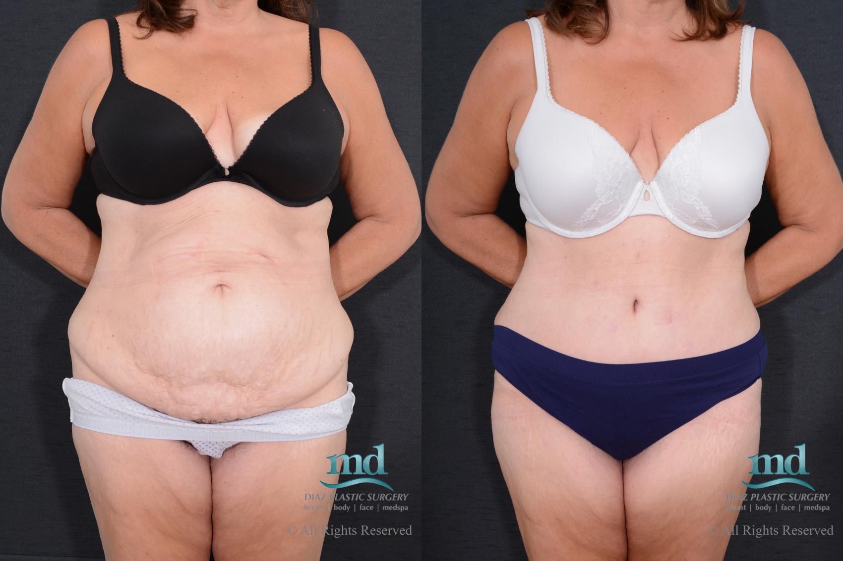 Before & After Tummy Tuck Case 77 View #1 View in Melbourne, FL
