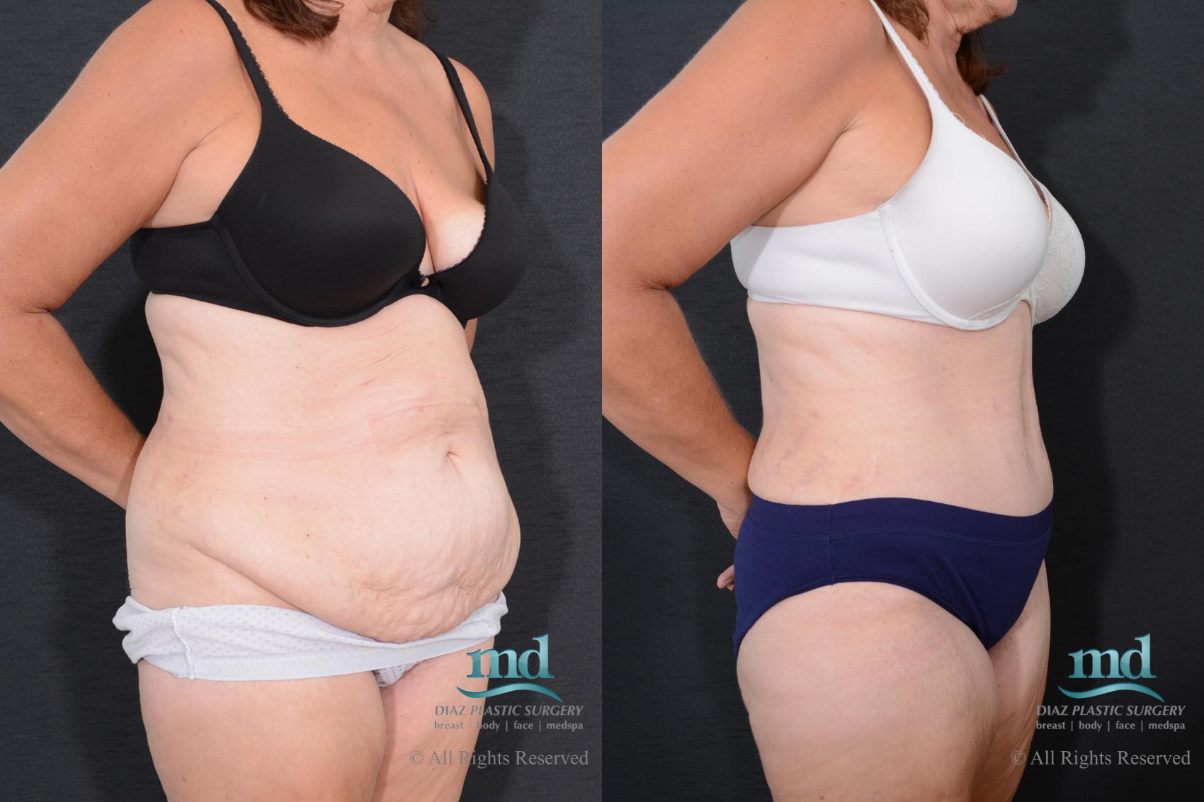 Before & After Tummy Tuck Case 77 View #2 View in Melbourne, FL