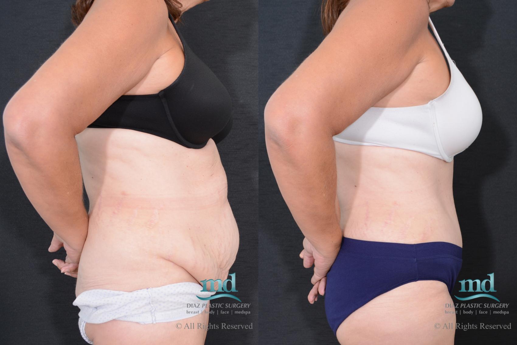 Before & After Tummy Tuck Case 77 View #3 View in Melbourne, FL