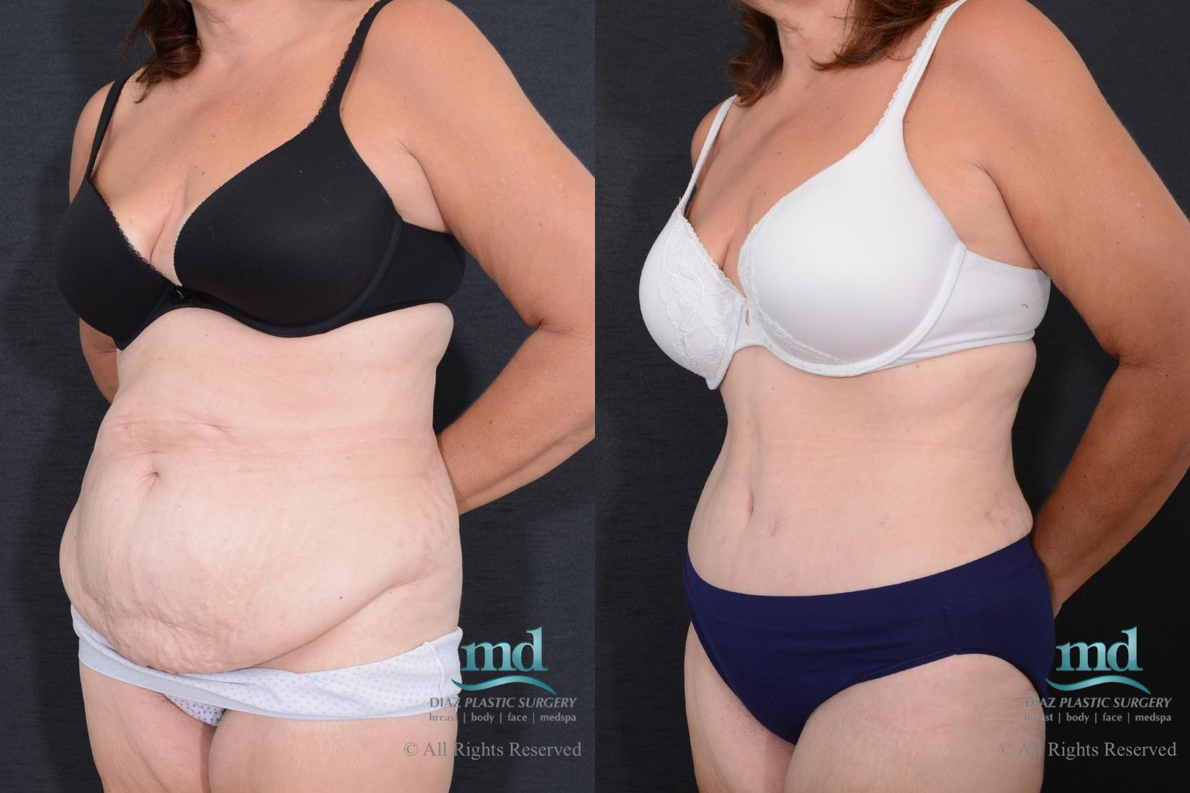 Before & After Tummy Tuck Case 77 View #4 View in Melbourne, FL