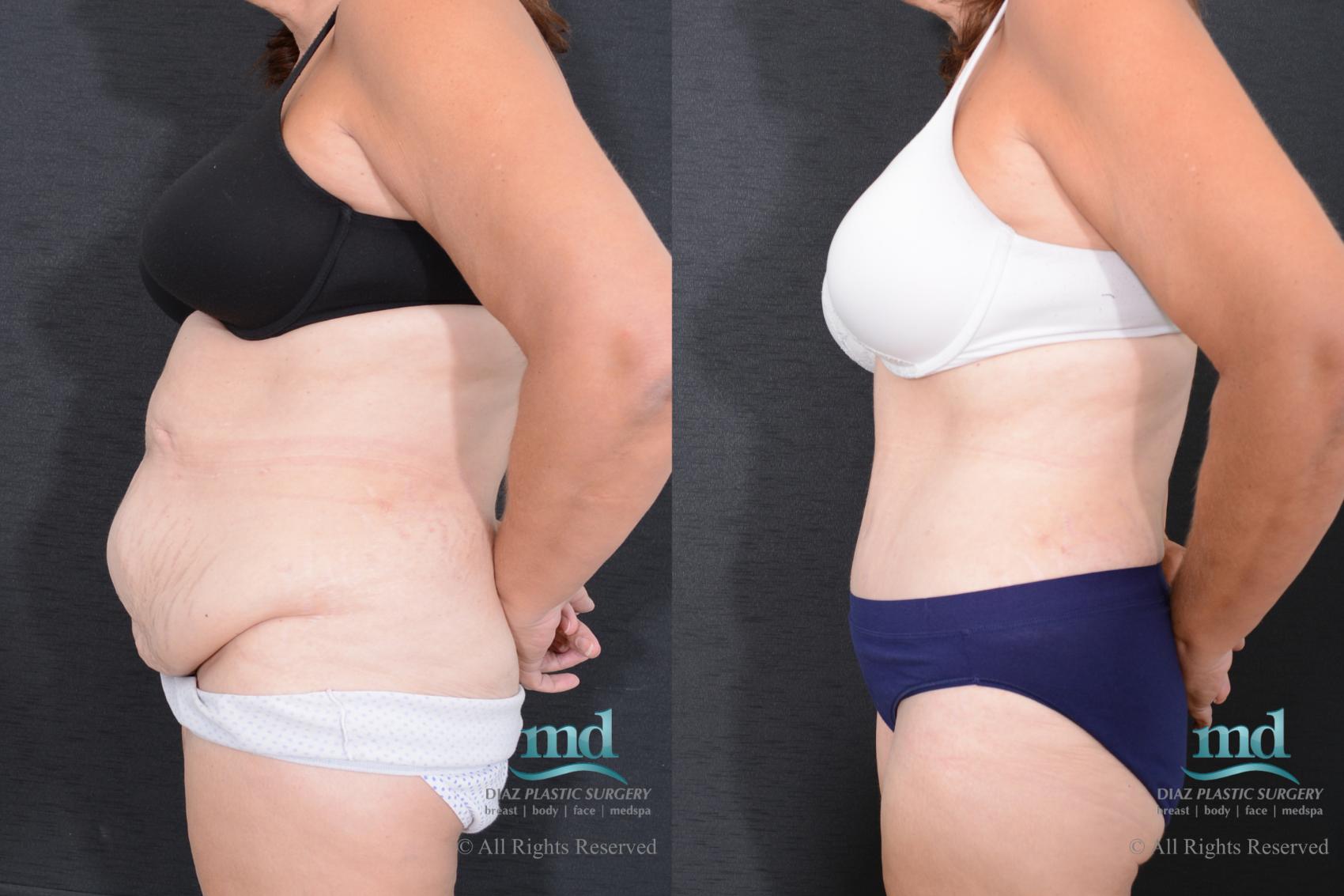 Before & After Tummy Tuck Case 77 View #5 View in Melbourne, FL