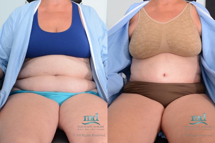 Before & After Tummy Tuck Case 78 View #1 View in Melbourne, FL