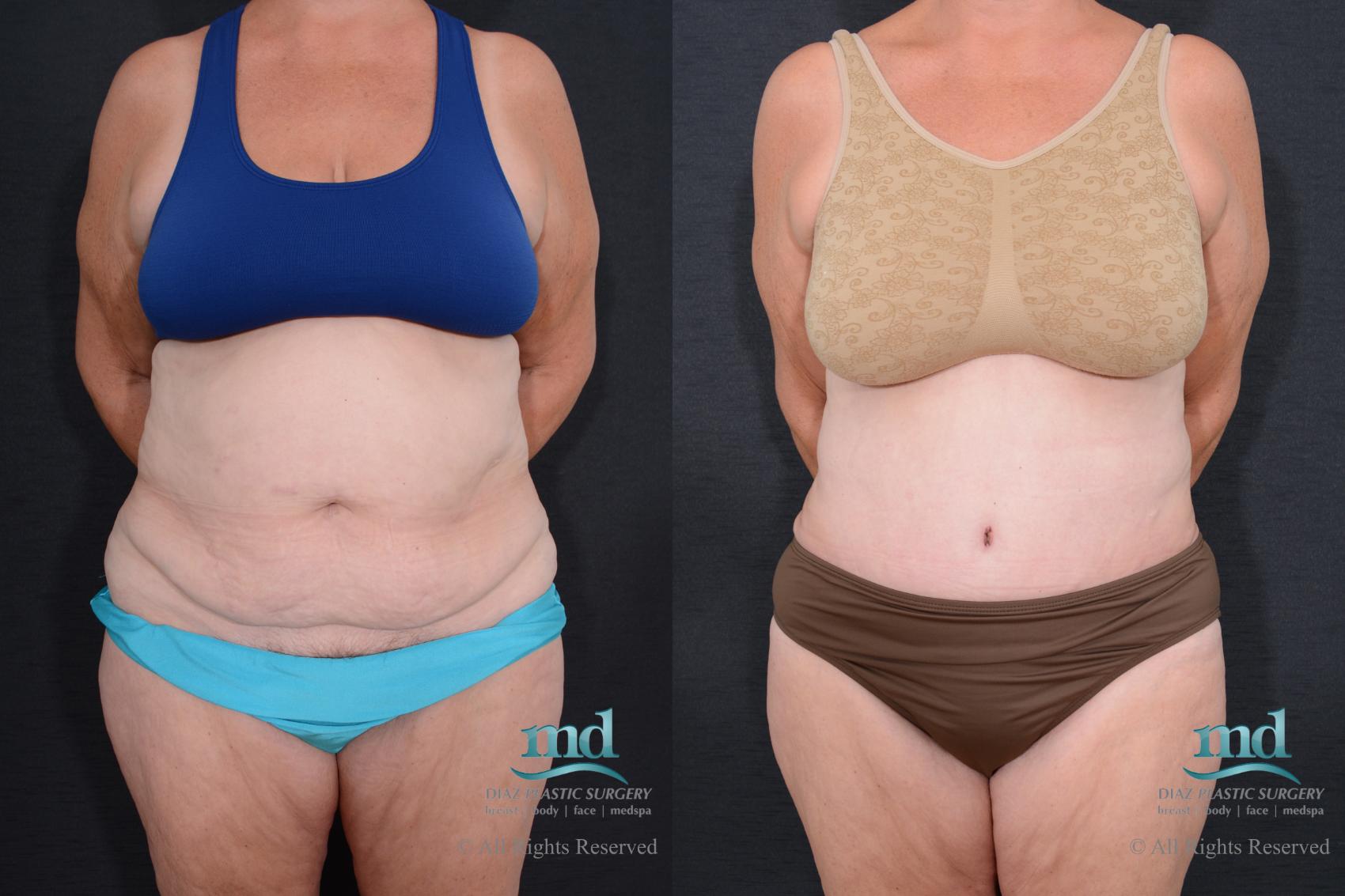 Before & After Tummy Tuck Case 78 View #2 View in Melbourne, FL