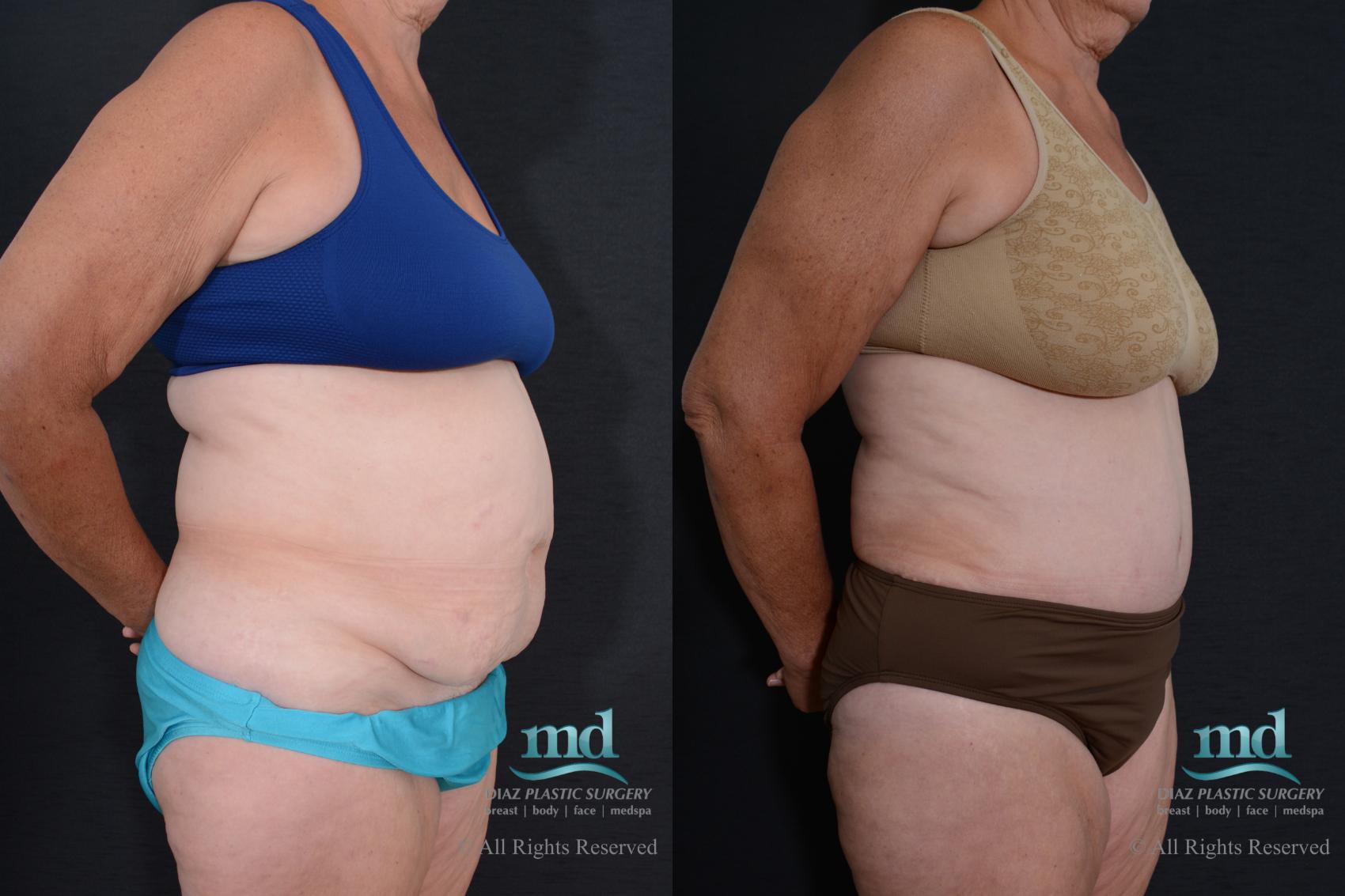 Before & After Tummy Tuck Case 78 View #3 View in Melbourne, FL