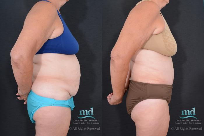 Before & After Tummy Tuck Case 78 View #4 View in Melbourne, FL
