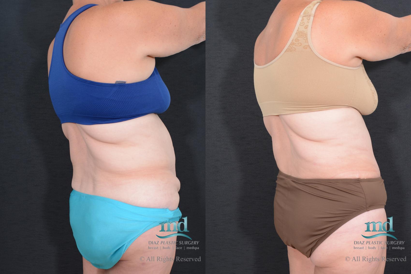 Before & After Tummy Tuck Case 78 View #5 View in Melbourne, FL