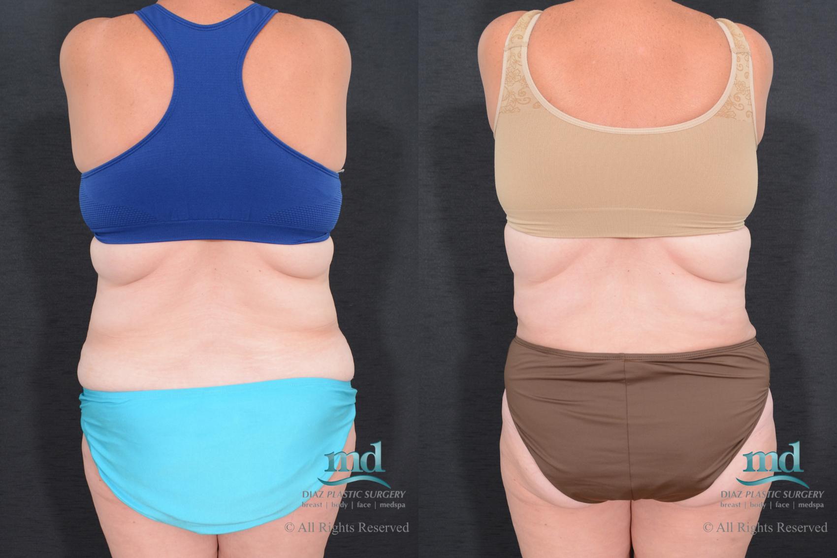 Before & After Tummy Tuck Case 78 View #6 View in Melbourne, FL