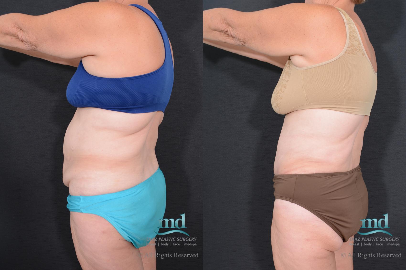 Before & After Tummy Tuck Case 78 View #7 View in Melbourne, FL