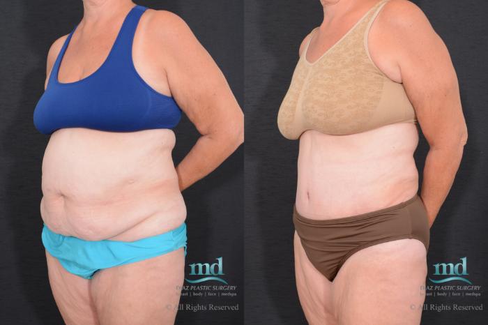 Before & After Tummy Tuck Case 78 View #8 View in Melbourne, FL