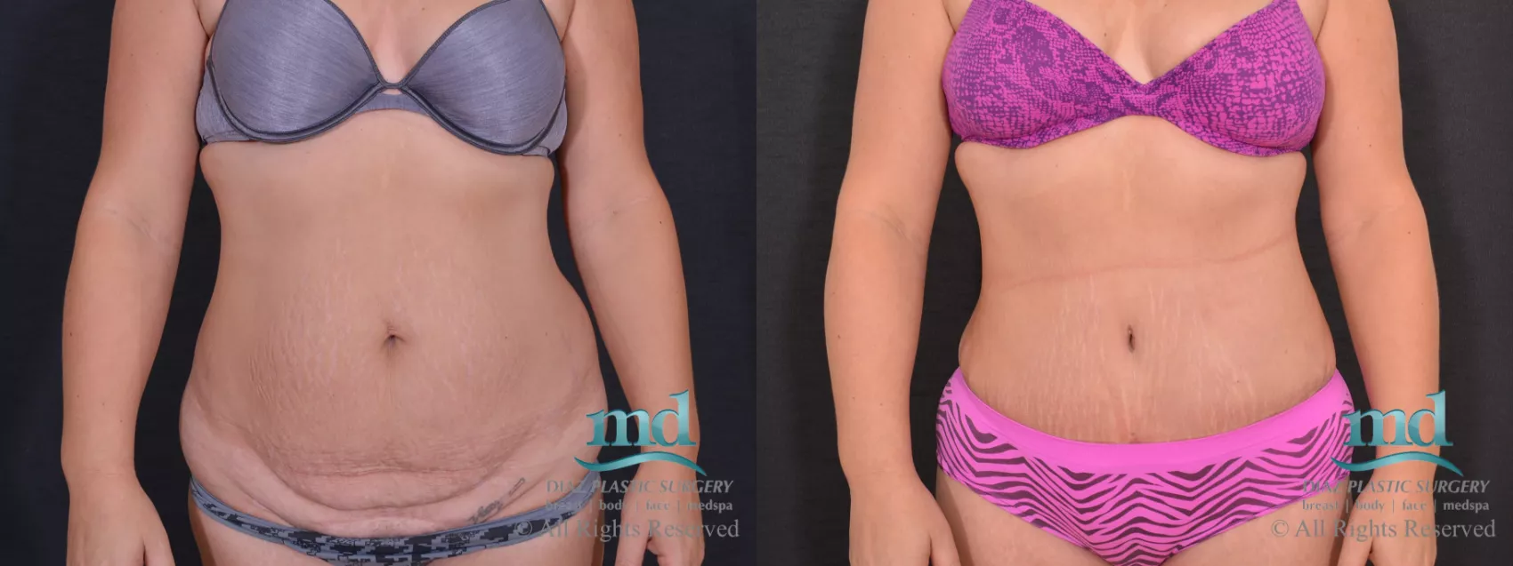 Tummy Tuck Before and After Photos Case 80