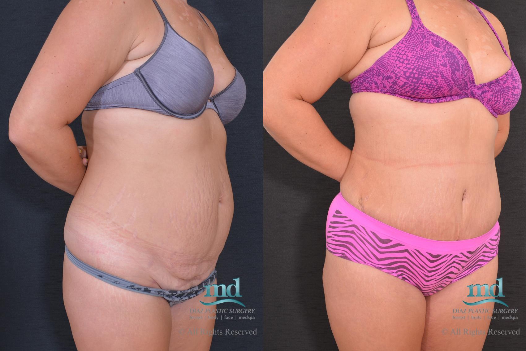 Before & After Tummy Tuck Case 80 View #2 View in Melbourne, FL