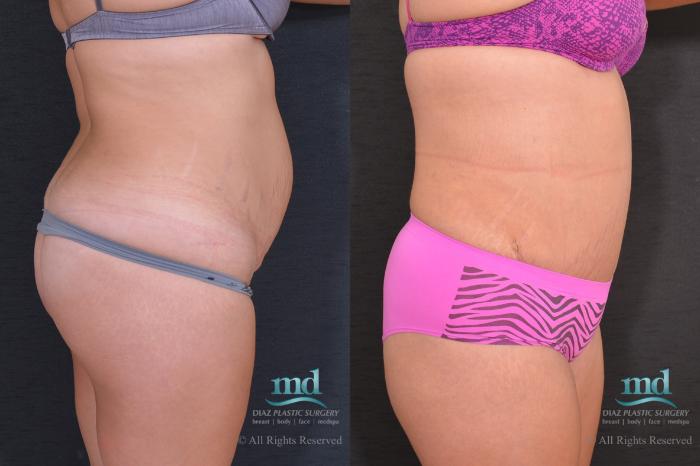Before & After Tummy Tuck Case 80 View #3 View in Melbourne, FL