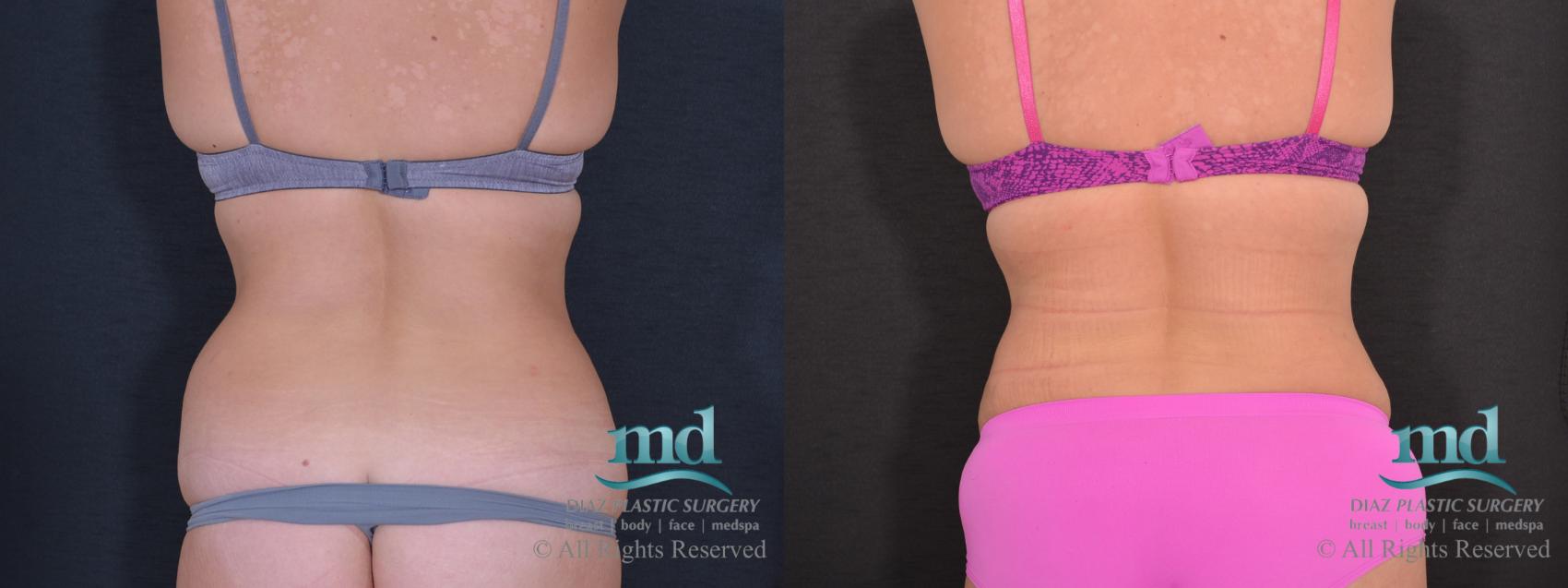 Before & After Tummy Tuck Case 80 View #4 View in Melbourne, FL