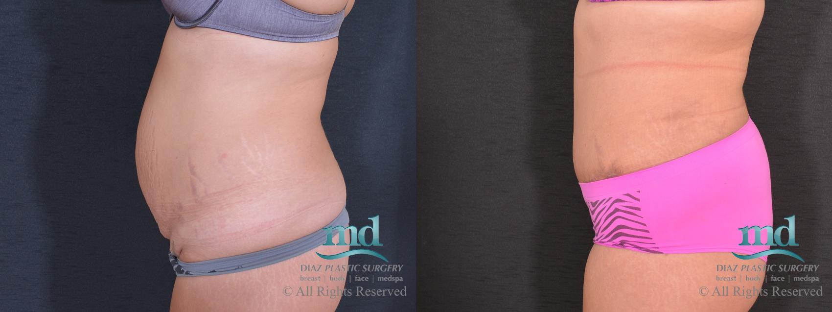 Before & After Tummy Tuck Case 80 View #5 View in Melbourne, FL