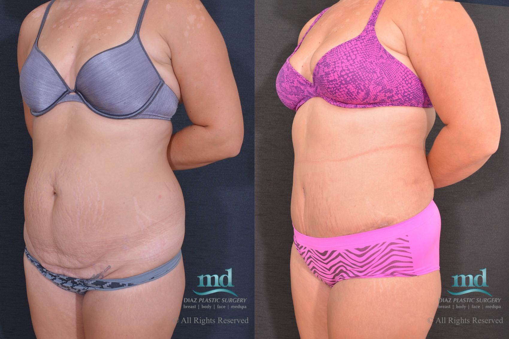 Before & After Tummy Tuck Case 80 View #6 View in Melbourne, FL