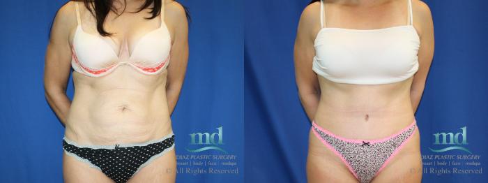 Before & After Tummy Tuck Case 82 View #1 View in Melbourne, FL