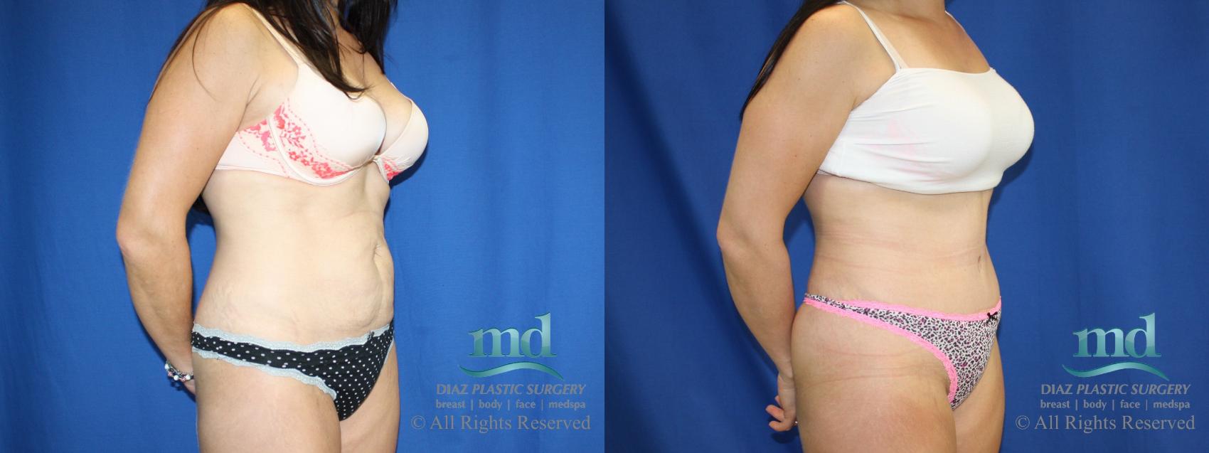 Before & After Tummy Tuck Case 82 View #2 View in Melbourne, FL
