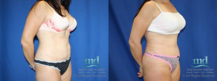 Before & After Tummy Tuck Case 82 View #2 View in Melbourne, FL