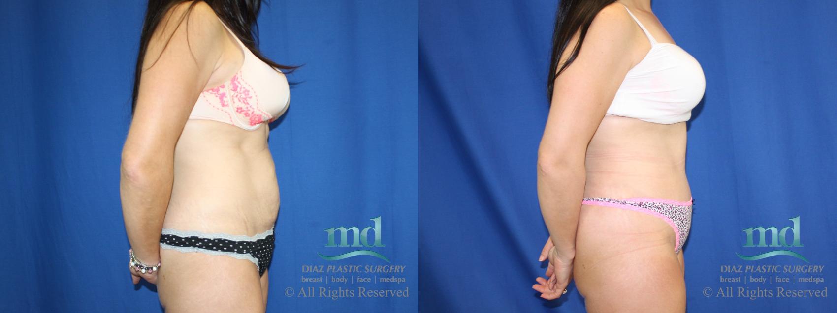 Before & After Tummy Tuck Case 82 View #3 View in Melbourne, FL
