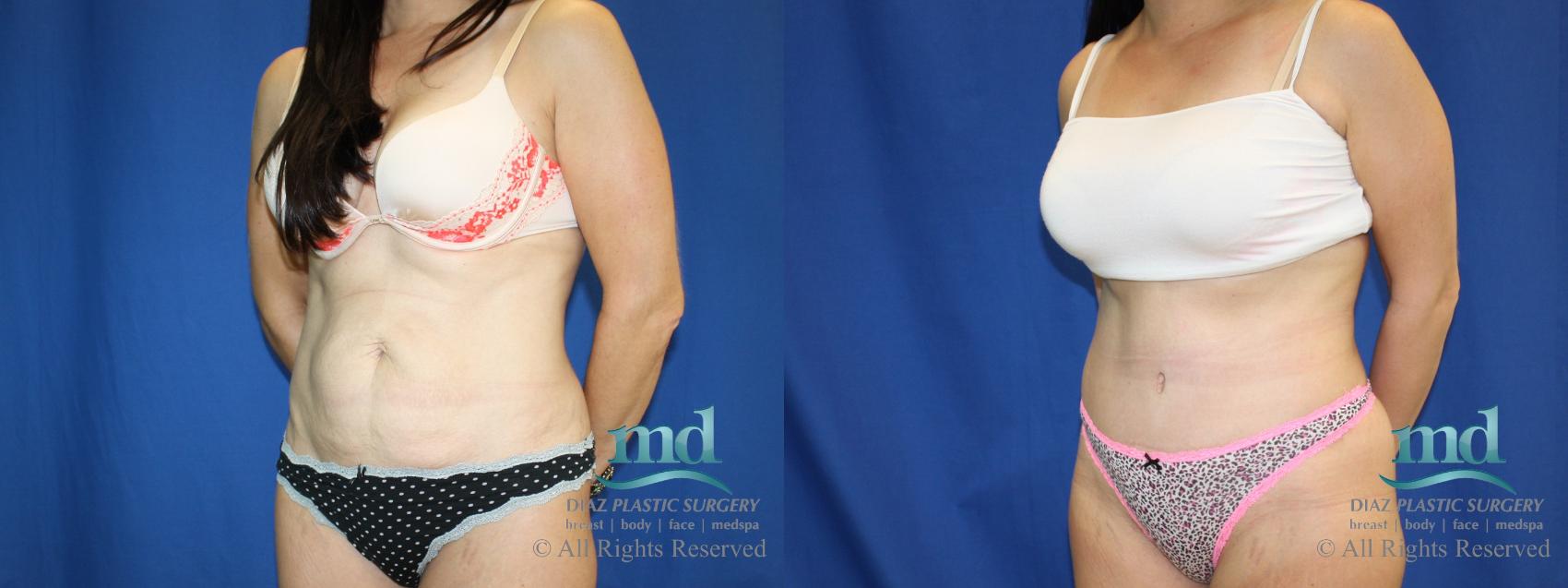 Before & After Tummy Tuck Case 82 View #4 View in Melbourne, FL