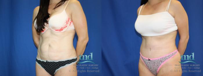 Before & After Tummy Tuck Case 82 View #4 View in Melbourne, FL