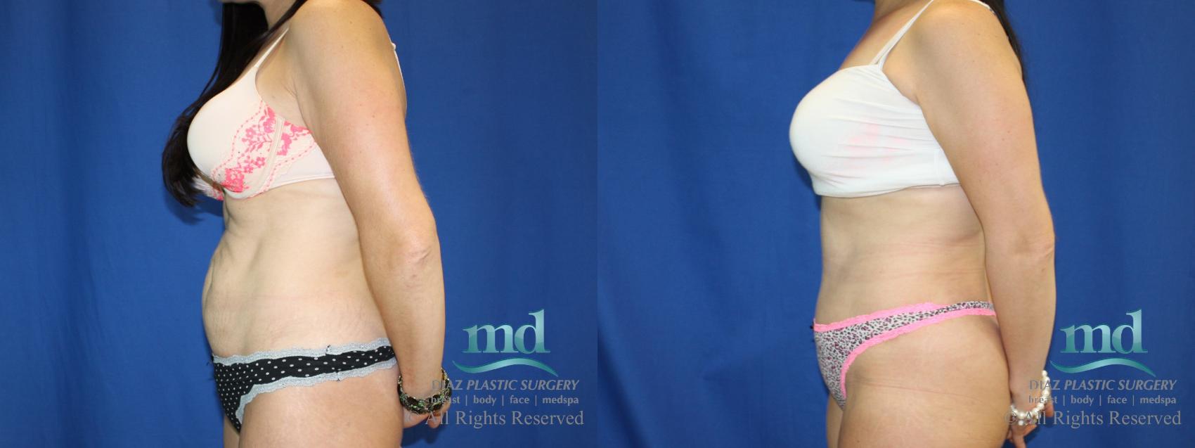 Before & After Tummy Tuck Case 82 View #5 View in Melbourne, FL